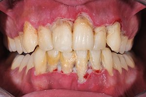 Recurrent inflammation of the gums