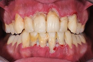 Periodontal disease