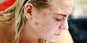 How to Deal with Acne? 4 Tricks to Fight Acne