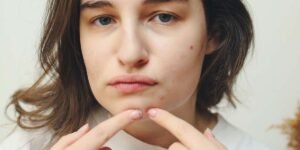 Non-stop Acne? Nine Causes of Pimple All Over the Face