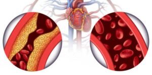 What is Chelation Therapy? Can it Treat Heart Disease? Understand the Uses and Side Effects of Chelation Therapy