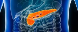 Is There a Relationship Between Diabetes and Pancreatic Cancer? 4 High-risk Groups to Pay Attention to